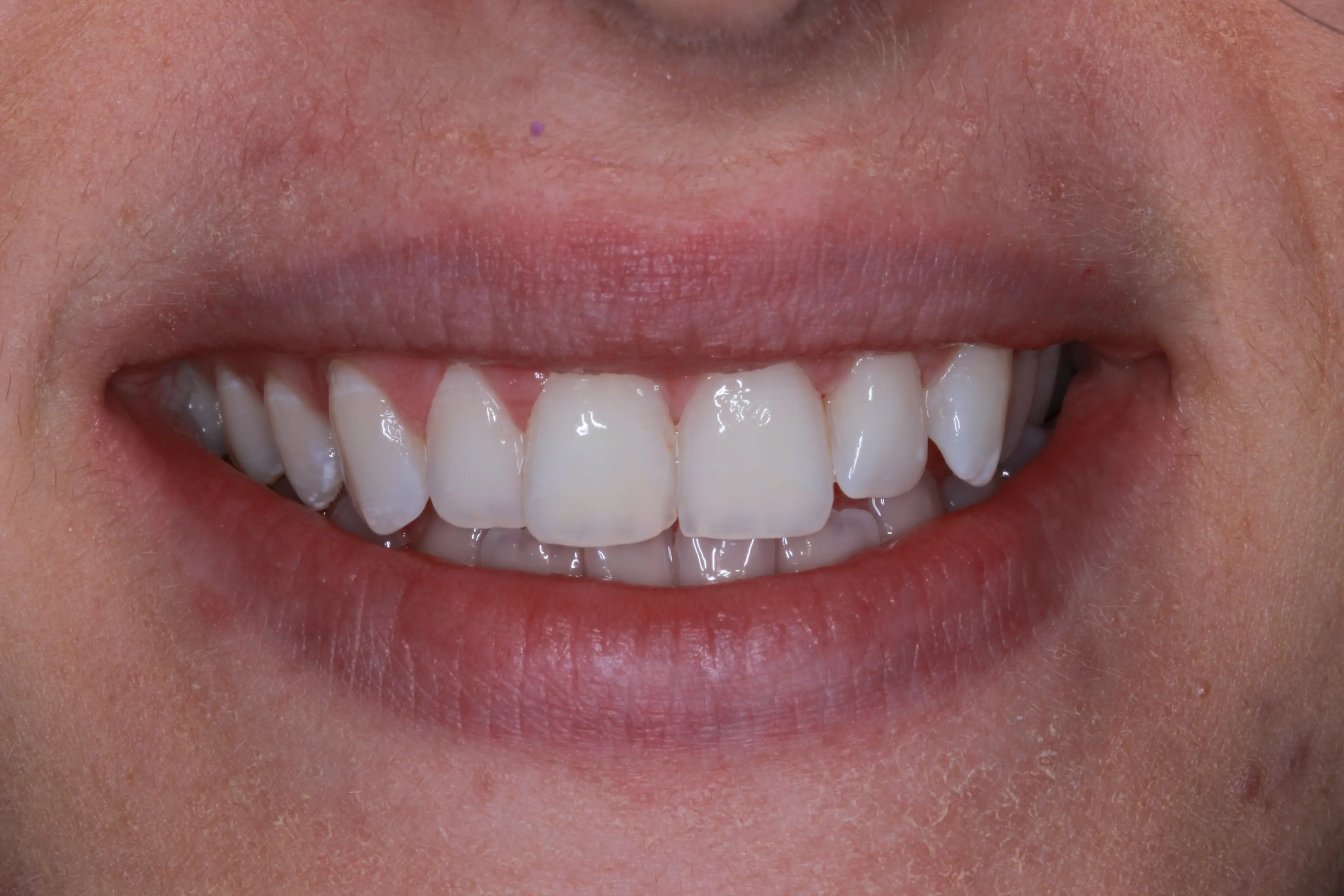 White spot removal and whitening